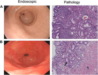 Transcriptome Analysis of lncRNA–mRNA Interactions in <mark class="highlighted">Chronic Atrophic Gastritis</mark>